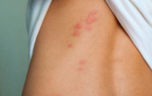 Best Vacuum for Bed Bugs - bed bug bite marks